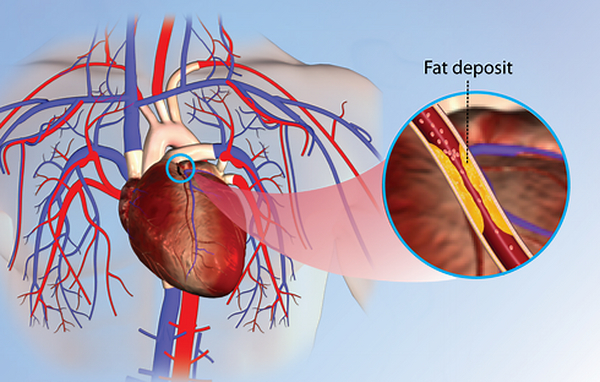 心绞痛（胸痛）